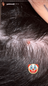 Gabi Brandt bate a cabeça e é internada