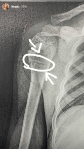 Filho de Pedro Scooby e Luana Piovani fratura o braço e pede pelo pai